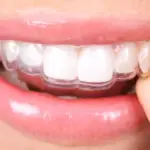 retainer